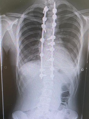 Erin's x-ray after surgery